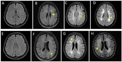 Neurofilament Light Chain Is a Promising Biomarker in Alcohol Dependence